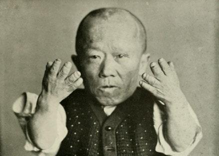 Retraso de las habilidades motoras en niños con acondroplasia