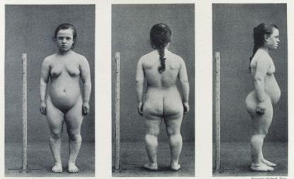 El diagnóstico se puede hacer al nacer sobre la base de ciertas características típicas de la acondroplasia 