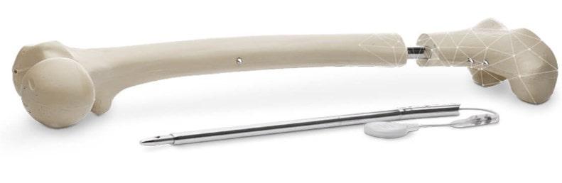 El tratamiento de la acondroplasia 