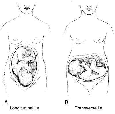 posición transversa bebé