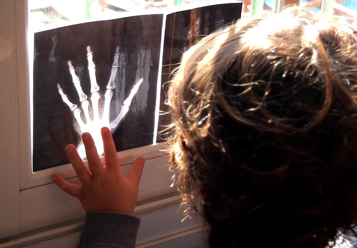 Mano de niño al lado de radiografia de mano en la ventana