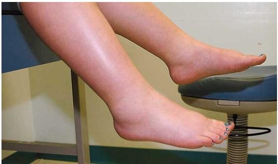 Causas de la retención de líquidos