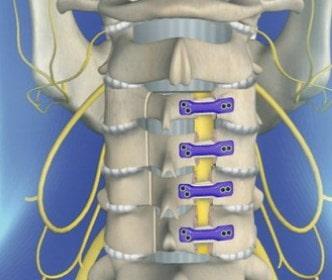 Para la mielopatía cervical avanzada, se recomienda una laminoplastia