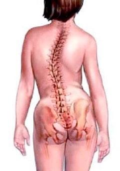 la escoliosis lumbar es idiopática