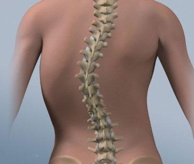 Causas de la radiculopatía