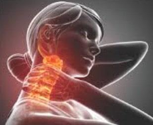 Radiculopatía cervical