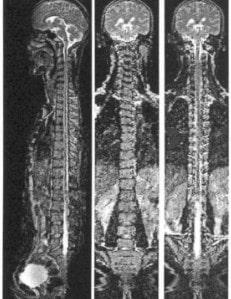 Diagnostico médico de la Espondilosis