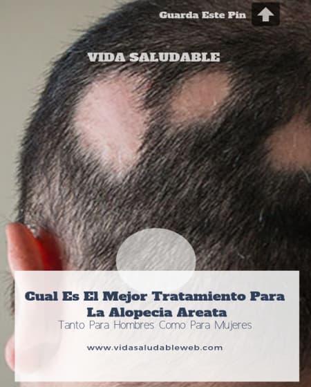 Tratamiento Casero Para La Alopecia Areata