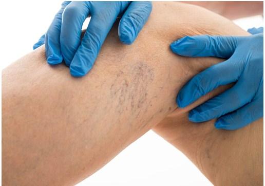 Causas de las varices