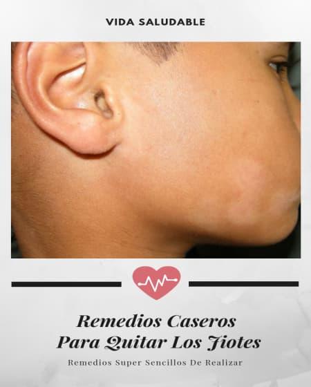 como curar los jiotes