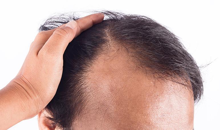 Cómo tratar la caída del cabello: diagnósticos y tratamientos - Trucos de salud caseros