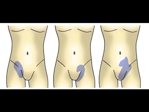 recuperacion psoas iliaco, ejercicio