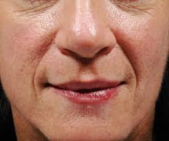 reducir líneas de sonrisa