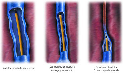 Procedimiento Radiofrecuencia