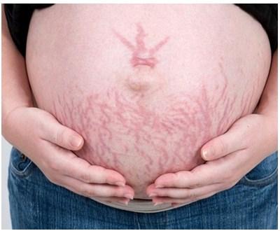 Soluciones para las estrías