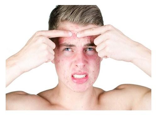 Remedios Caseros o tratamientos para el acne