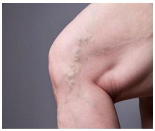 Peligros de la trombosis venosa