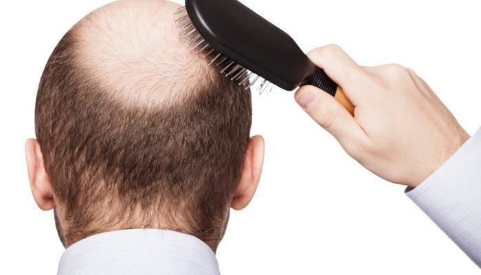 ¿Cómo se relacionan la caspa y la caída del cabello?