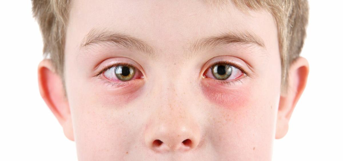 conjuntivitis infantil