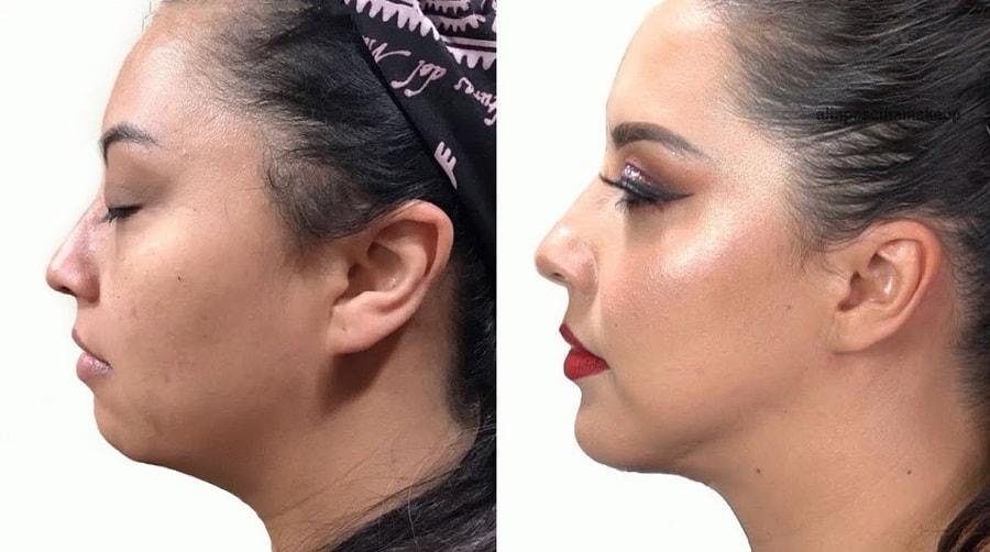 cirugia de papada antes y despues