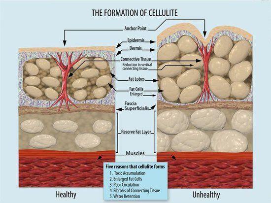 Resultado de imagen de cellulite phases
