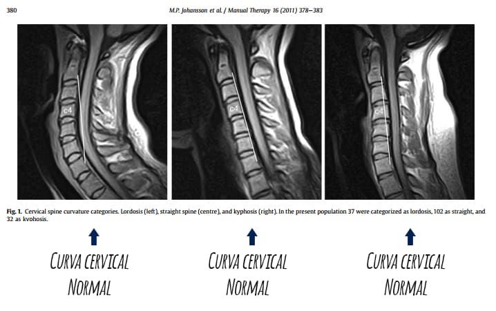 Rectificación-cervical Johanson