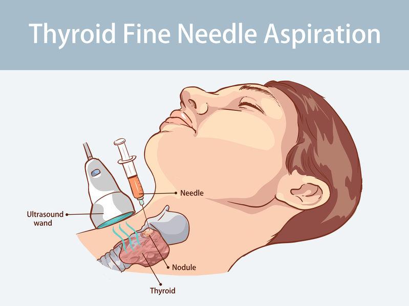 puncion biopsia del tiroides