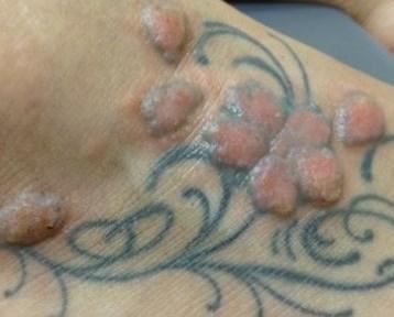 Riesgo de los tatuajes en la columna vertebral