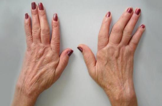 manos artritis reumatoide