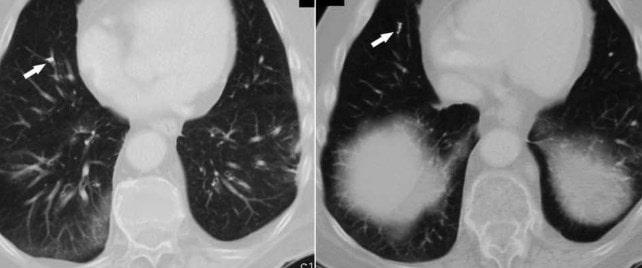Posibles riesgos de una vertebroplastia