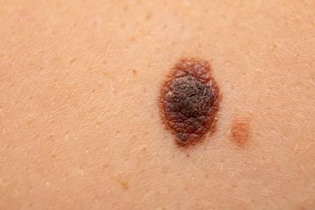 Detección precoz del cáncer de piel.