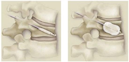 Cifoplastia para el tratamiento de fracturas espinales