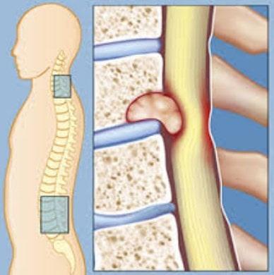 Aplicaciones de la cifoplastia