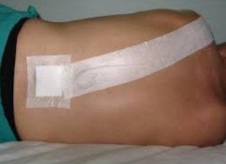 Cuidados después de la cirugía