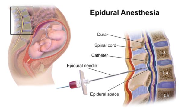 todo lo que debes saber sobre la epidural en el parto