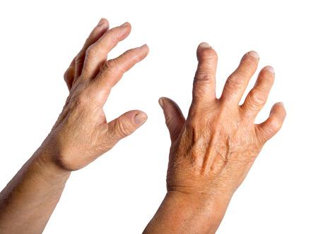 la artritis reumatoide