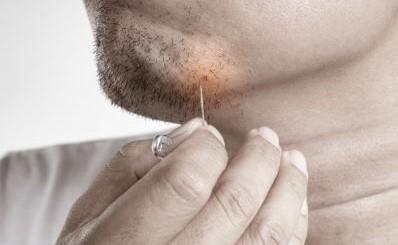 Por qué aparecen los pelos enquistados en la barba