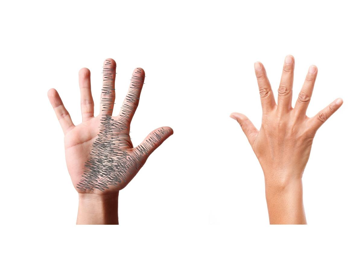 Diagrama de Katz en el síndrome del túnel carpiano