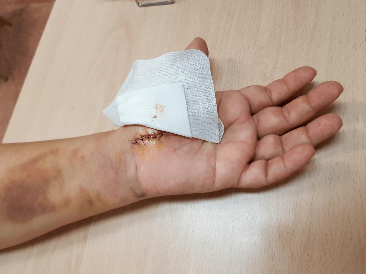 Cirugía abierta en el síndrome del túnel del carpo