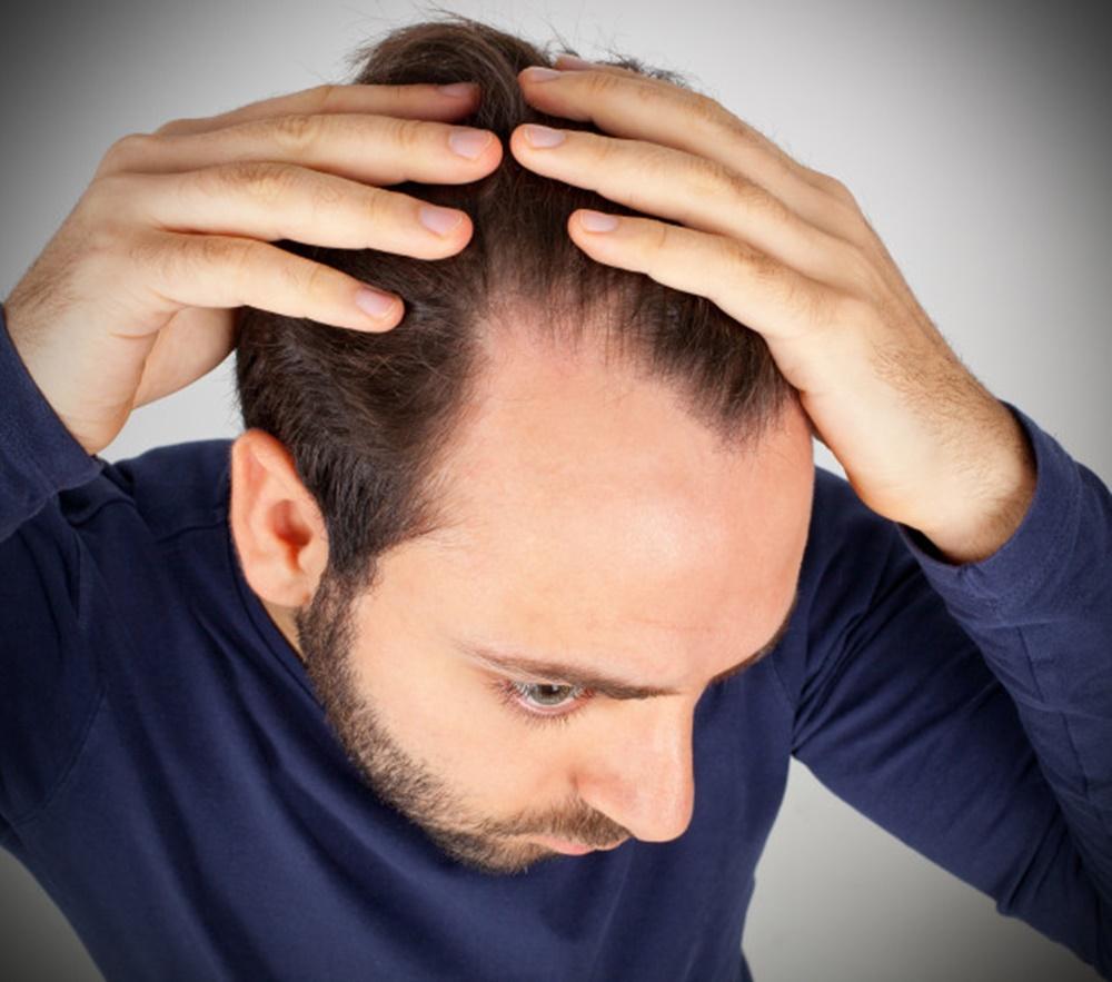 Las principales causas de pérdida de cabello en los hombres