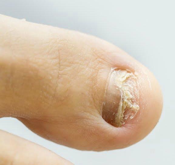 remedios caseros para los hongos en las uñas