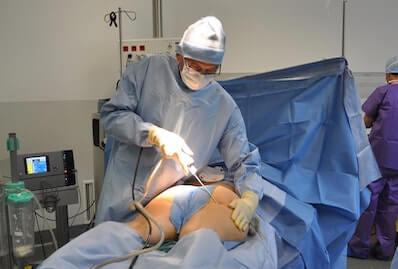 Liposucción glúteos