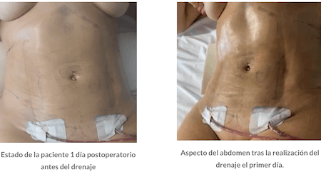 Antes y después liposucción Vaser