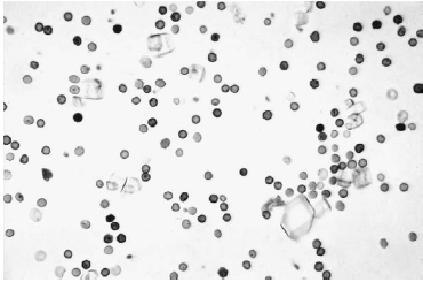 Sedimento urinario de un gato con CIF, se evidencia la presencia de células rojas y escasas células blancas. La presencia de cristaluria no indica que es la causa de los signos clínicos. Un urotelio normal no debe verse afectado por la presencia de cristales (Hostutler et al)