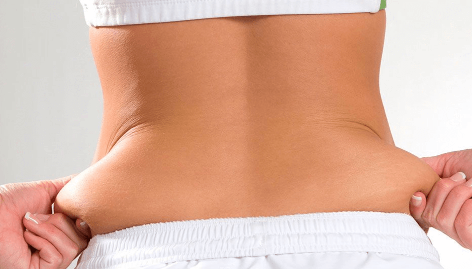 flacidez-abdominal12
