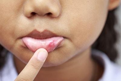 Remedios caseros para las llagas en la boca