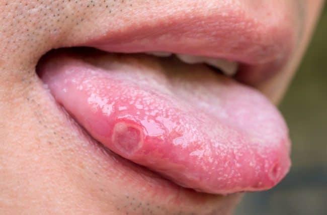 remedios caseros para las llagas en la lengua