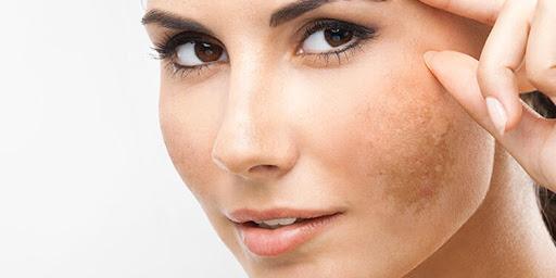 hiperpigmentacion rostro
