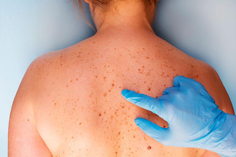 hiperpigmentacion-tratamiento