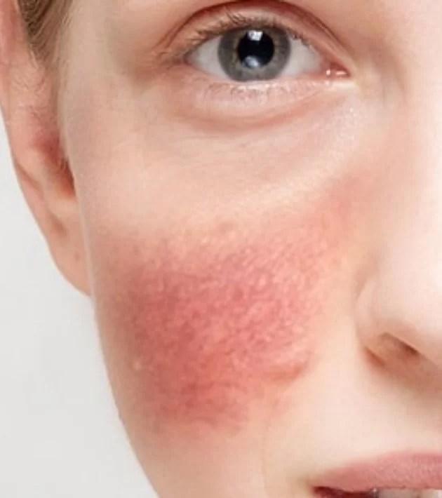 tipo de piel sensible intolerante